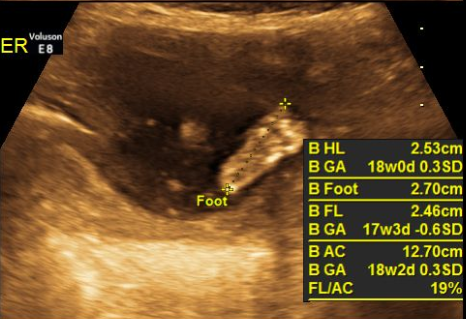 Week 18 twin sonogram foot new dads on the block